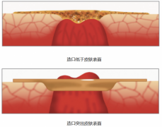造口护理：为什么要使用凸面底盘？
